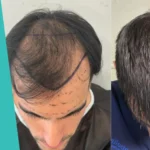 Juan dhi hair ransplant
