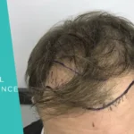 Mature Hairline vs Receding Hairline