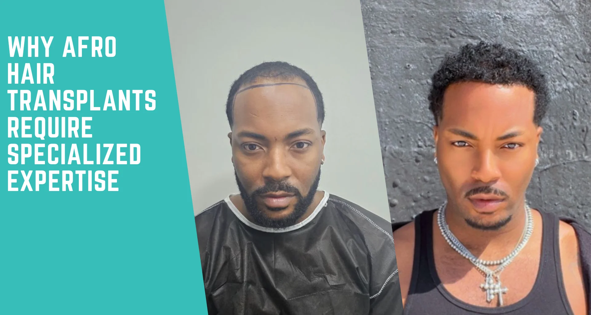Why Afro Hair Transplants Require Specialized Expertise