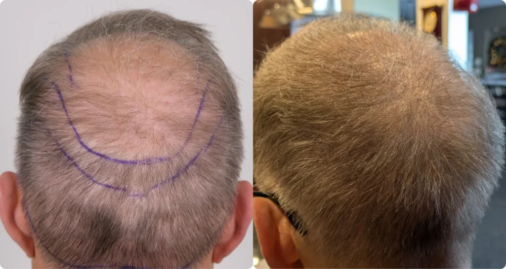 Dan Caverly's Hair Transplant Before and After: 3,500 Grafts DHI for Crown Density at UniquEra 1 Dan Caverly's Hair Transplant