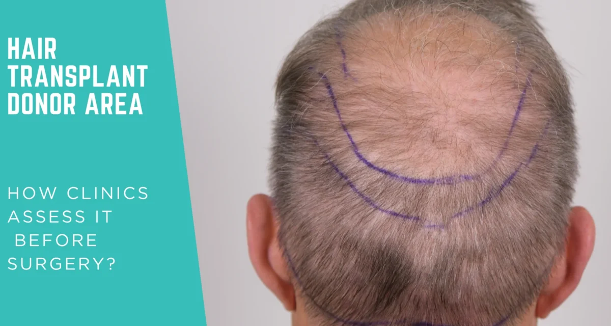 Hair Transplant Donor Area: How Clinics Assess It Before Surgery