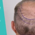 Hair Transplant Donor Area