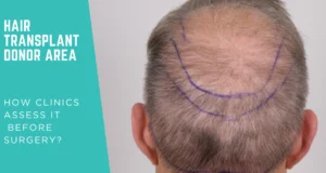 Hair Transplant Donor Area