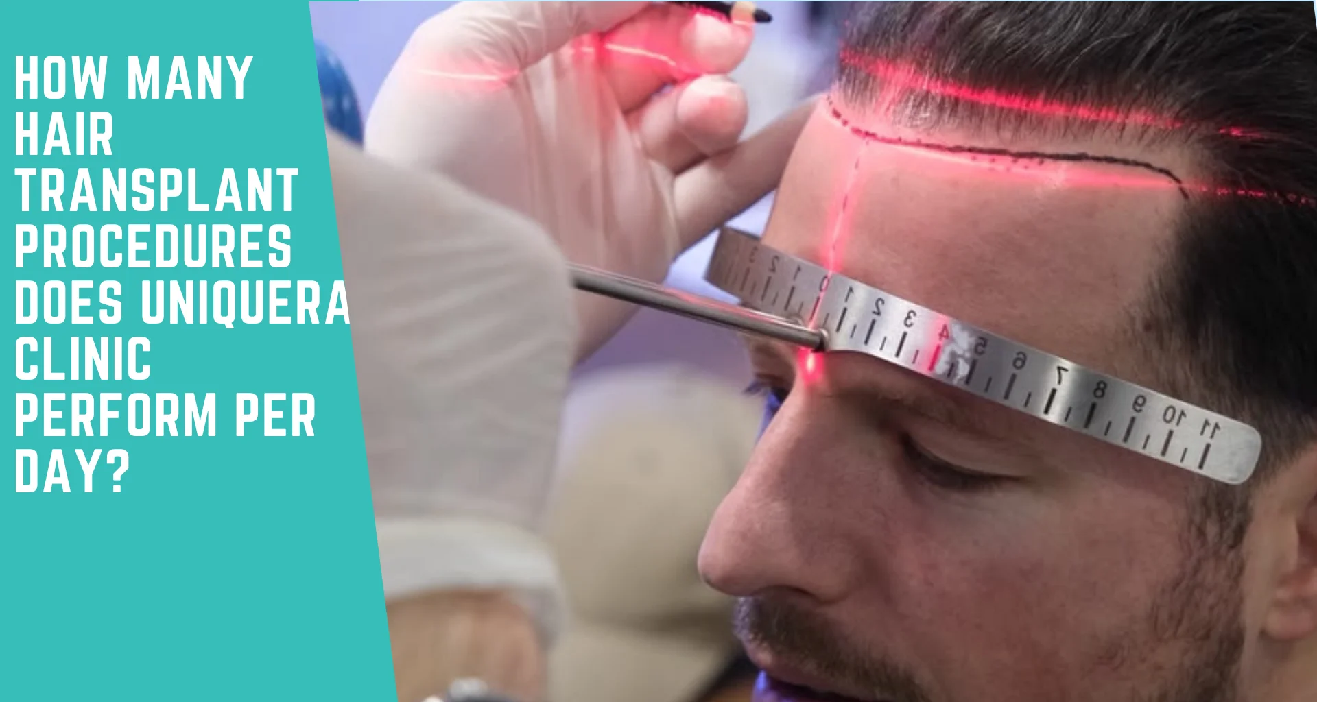 How Many Hair Transplants Does UniquEra Clinic Perform Per Day?