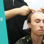 How UniquEra Clinic Designs a Personalized Hair Transplant Plan?