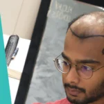 Hair Transplant Results