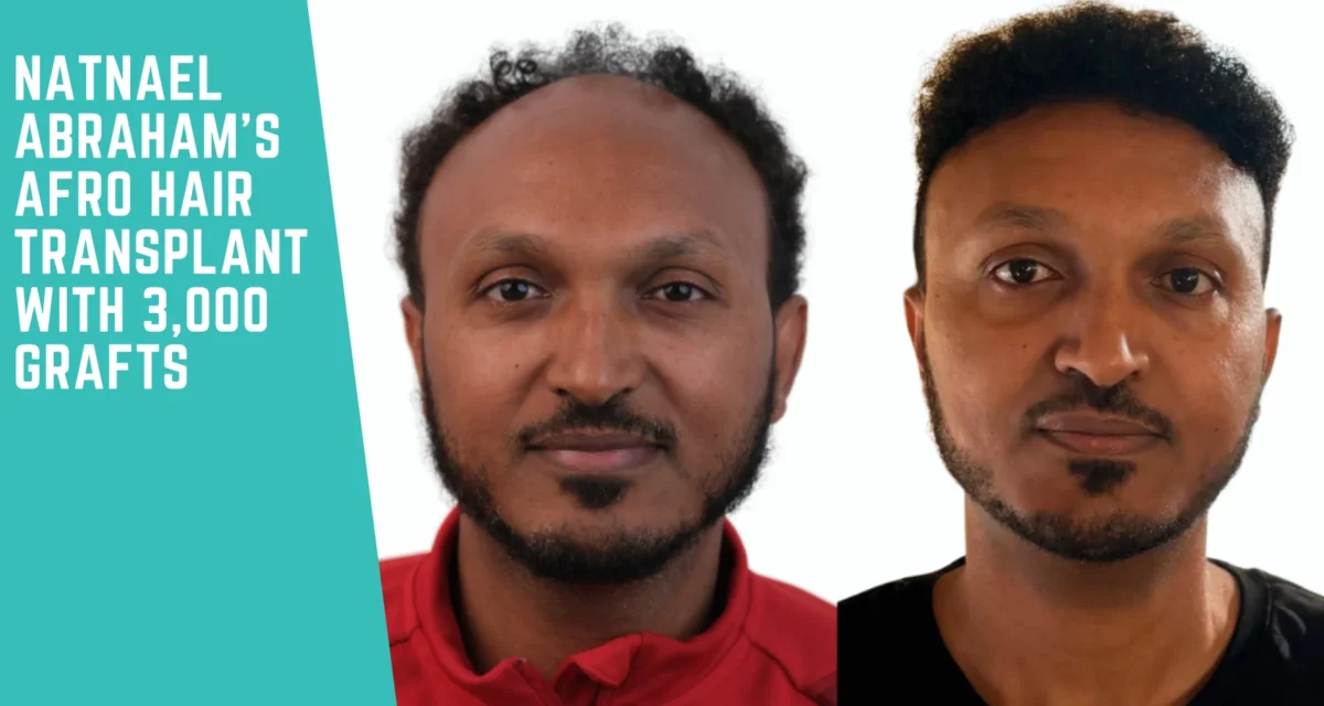 Natnael Abraham’s Afro Hair Transplant with 3,000 Grafts