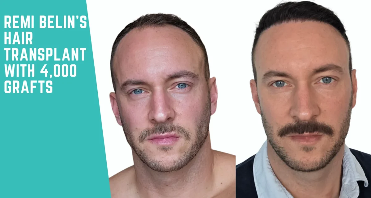 Remi Belin’s DHI Hair Transplant with 4,000 Grafts