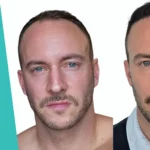 Remi Belin's DHI Hair Transplant with 4,000 Grafts
