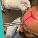 Who performs hair transplant surgery