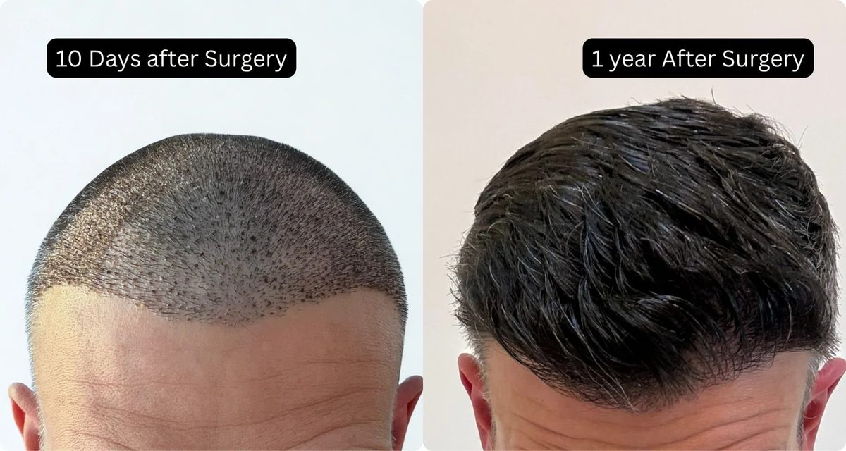 Kris Smithers’ DHI Hair Transplant with 2,500 Grafts at UniquEra Clinic