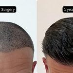 Kris Smithers' DHI Hair Transplant