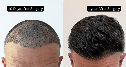 Kris Smithers' DHI Hair Transplant