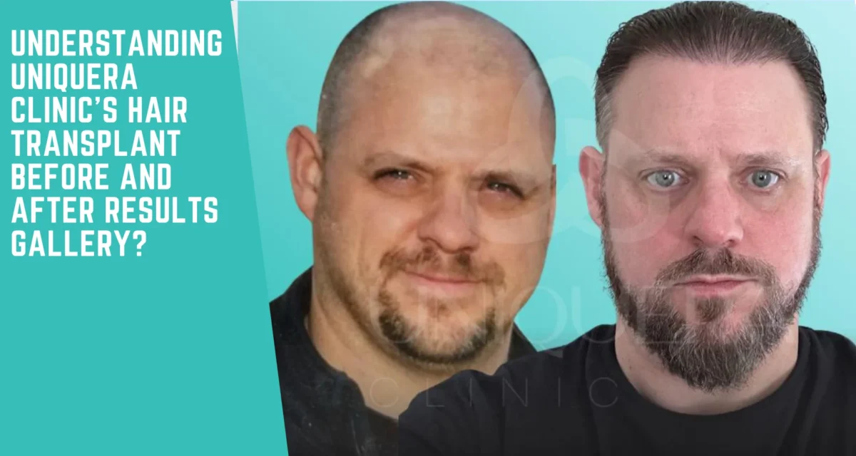 Understanding UniquEra Clinic’s Hair Transplant Before and After Results Gallery
