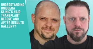 Understanding UniquEra Clinic’s Hair Transplant Before and After Results Gallery