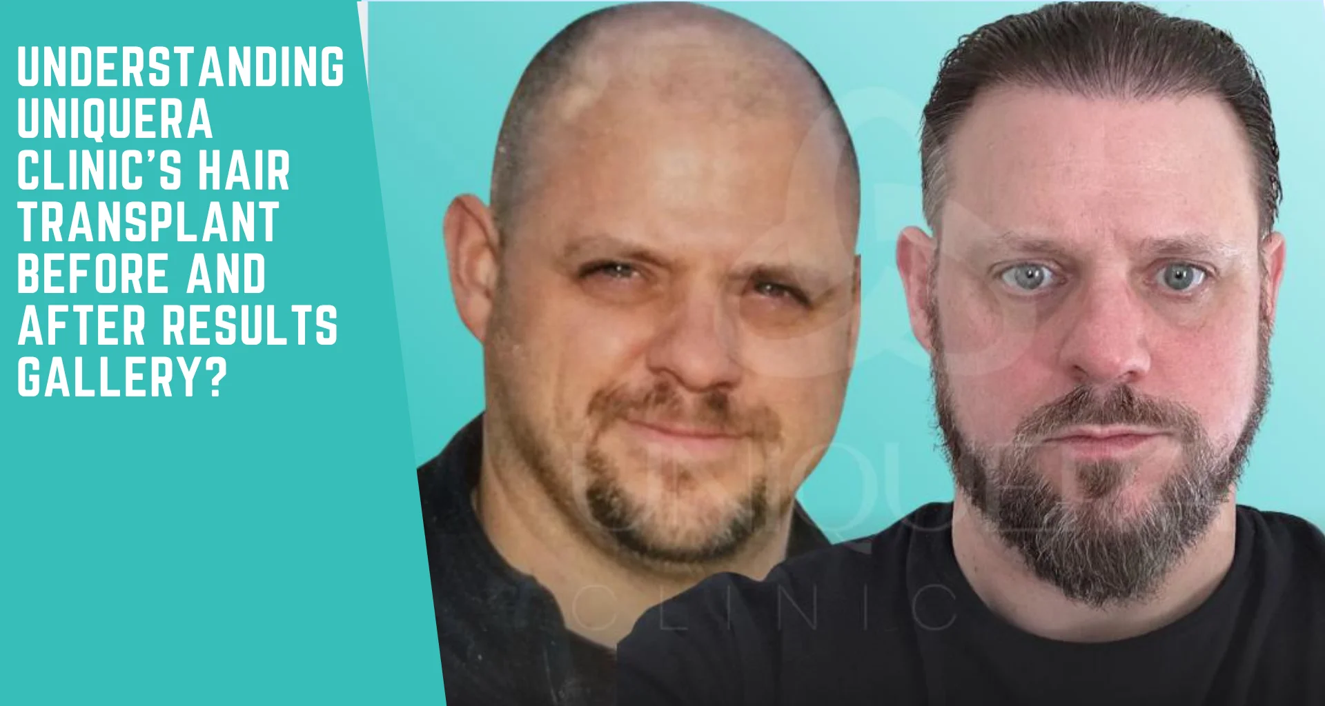 Understanding UniquEra Clinic’s Hair Transplant Before and After Results Gallery