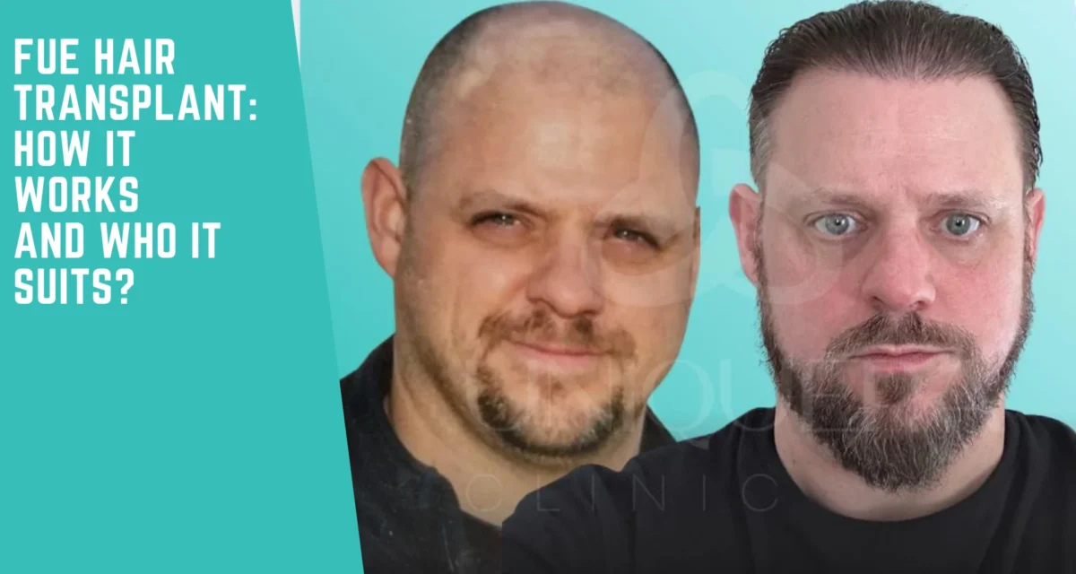 FUE Hair Transplant: How It Works and Who Is a Good Candidate