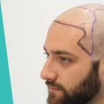 Donor Hair for Future Hair Loss