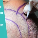 Why UniquEra Hair Transplant Clinic Does Not Promise Unlimited Grafts to Every Patient
