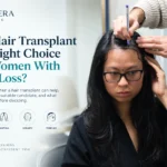 Hair Transplant for Women