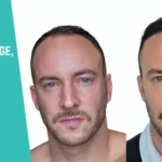 4000 Grafts Hair Transplant