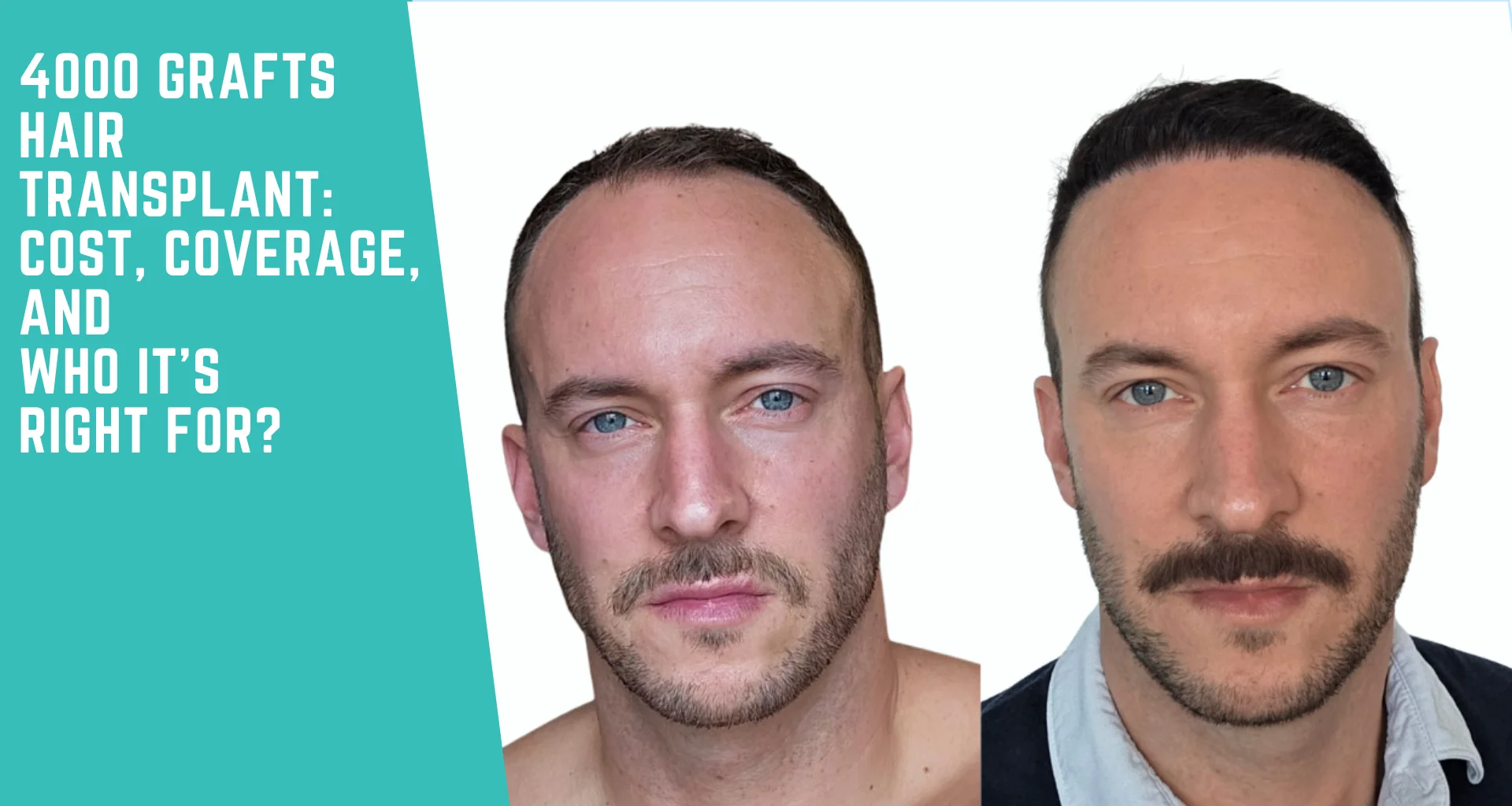 4000 Grafts Hair Transplant: Cost, Coverage, and Who It’s Right For