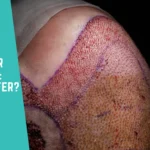 Topical Finasteride vs Oral Finasteride After a Hair Transplant Which Is Safer
