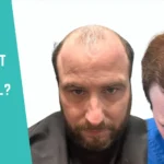 What Makes a Hair Transplant Result Successful?