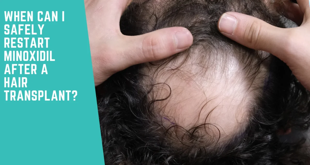 When Can I Safely Restart Minoxidil After a Hair Transplant, and Does Everyone Actually Need It?