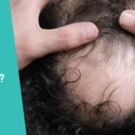 When Can I Safely Restart Minoxidil After a Hair Transplant