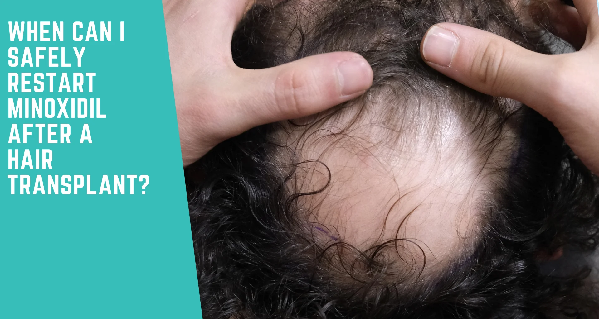 When Can I Safely Restart Minoxidil After a Hair Transplant, and Does Everyone Actually Need It?