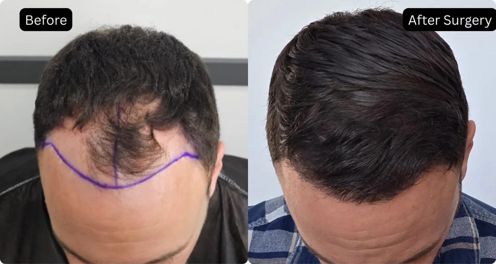 4000 Grafts Hair Transplant: Cost, Coverage, and Who It's Right For 1 image