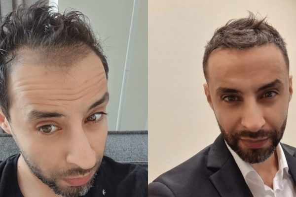Before after hair transplant
