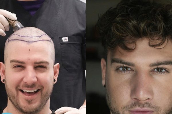 Before after hair transplant
