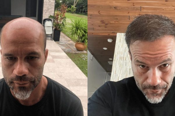 Before after hair transplant