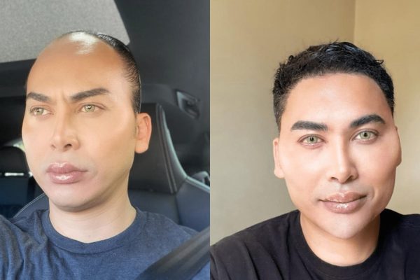 Before after hair transplant