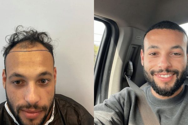 Before after hair transplant