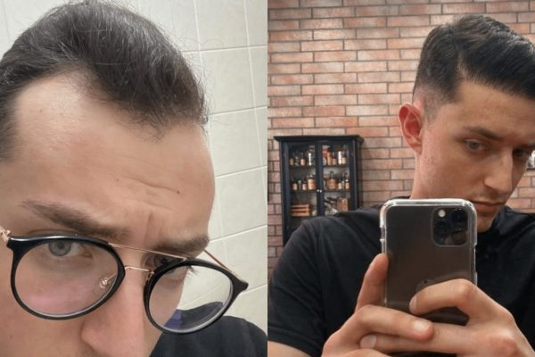 Before after hair transplant