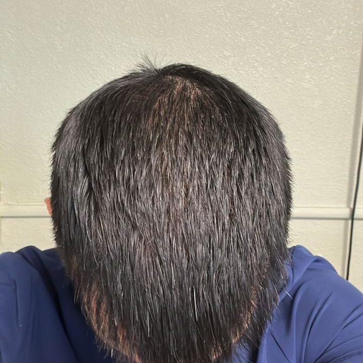 VIP Luxury Hair Transplant in Istanbul 17 after aligned r9o0aaqt3gqh79awwbi6r3s4kgi2pwe0cfjitop4ps