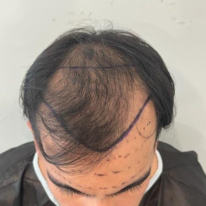 VIP Luxury Hair Transplant in Istanbul 16 before aligned r9o0acmhh4t1uh86lcbfw3b1r88t5alh0ouhs8mcdc